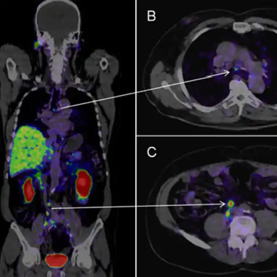 PSMA PET Scan For Prostate